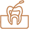 Root Canal Treatment