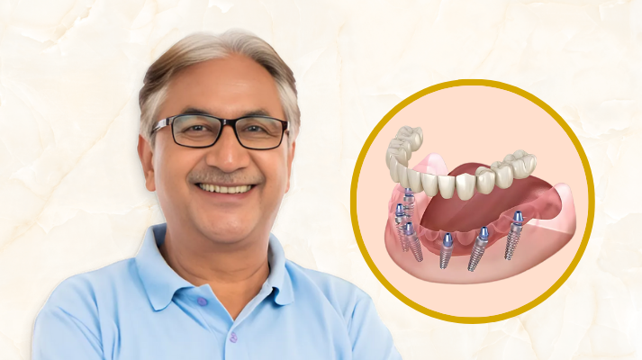 Full Mouth Rehabilitation Treatment In Raghavendra Colony Kondapur
