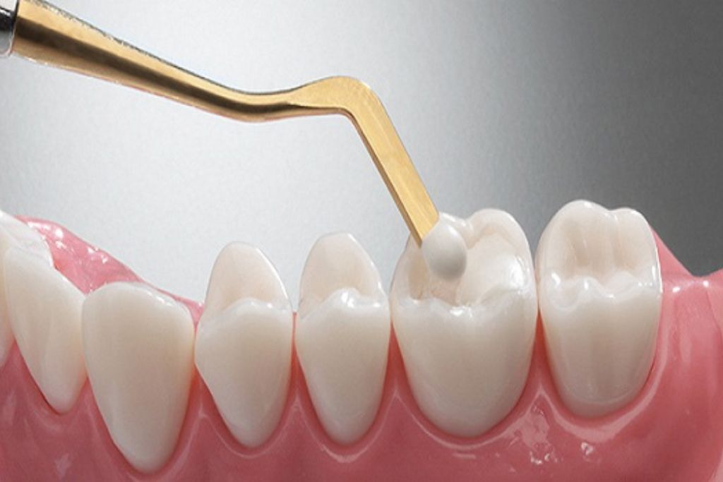 Tooth Colored Filling In Kondapur
