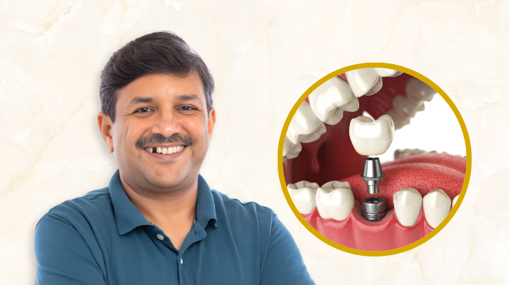 Missing Tooth Treatment