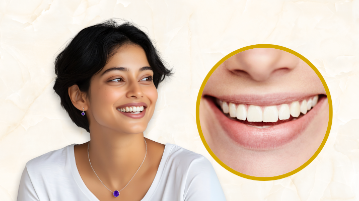 Smile Makeover 