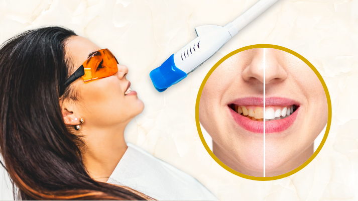 Teeth Whitening In Kondapur