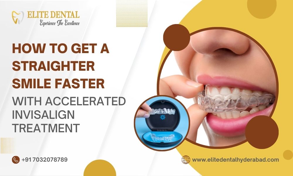 How to Get a Straighter Smile Faster With Accelerated Invisalign Treatment