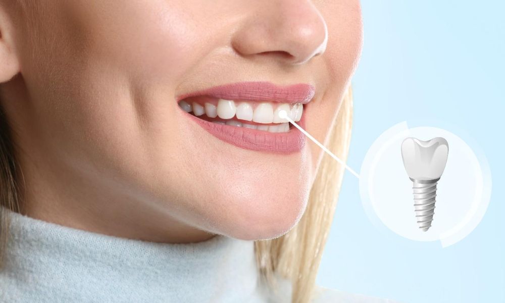 What are Dental Implants and Why are They Worth the Investment?