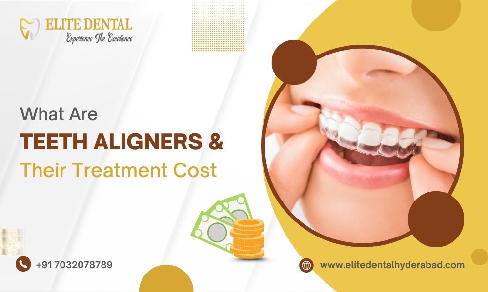 What Are Teeth Aligners & Their Treatment Cost