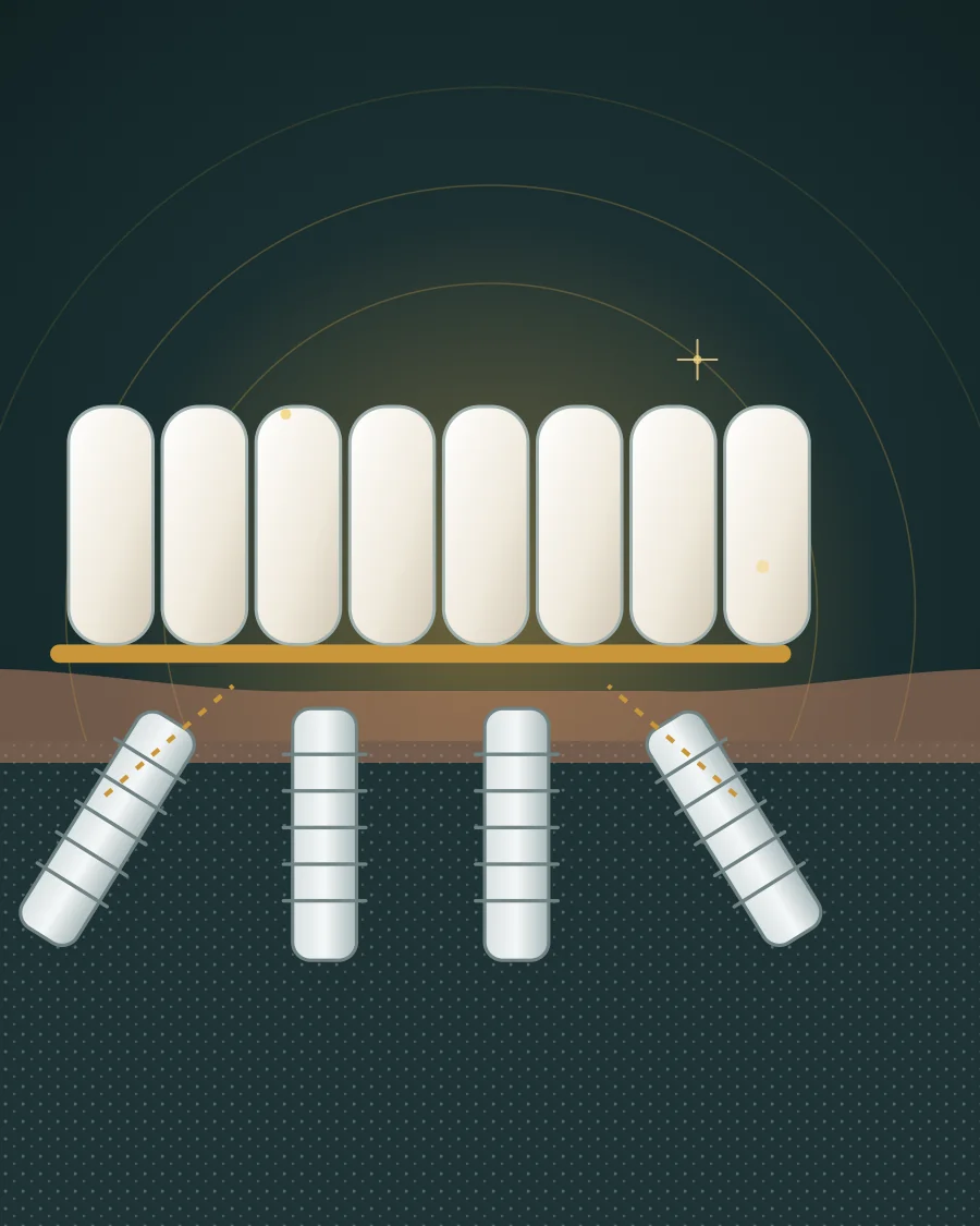 Illustration of a full arch of teeth fixed on four implants, the back two tilted outward, drawn in Elite Dental gold and charcoal