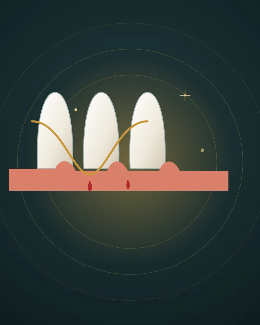 Illustration of three teeth with floss between them and red gums bleeding where the floss touches, drawn in Elite Dental gold and charcoal