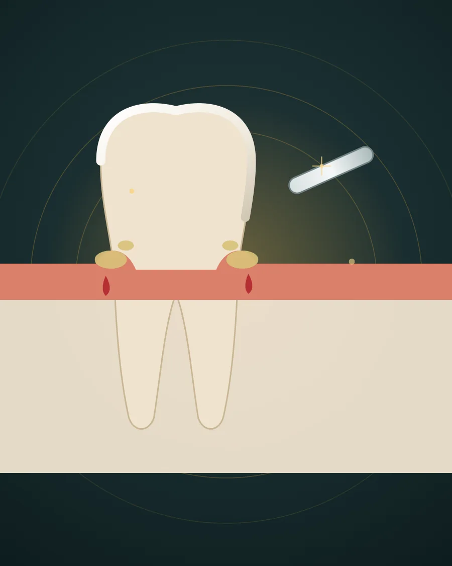 Illustration of a tooth with red gum that is bleeding at the gum line while a toothbrush touches it, drawn in Elite Dental gold and charcoal