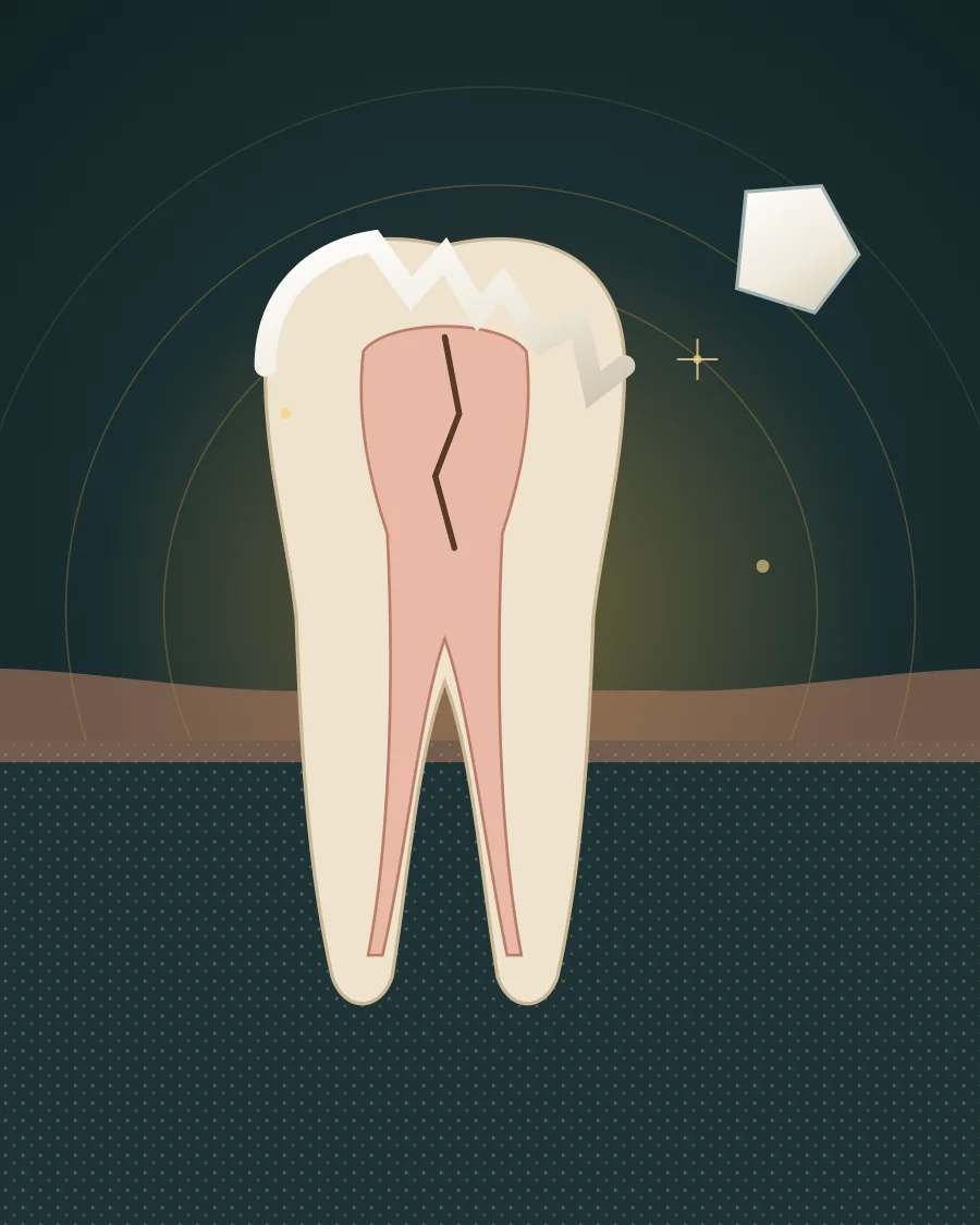 Illustration of a back tooth with a jagged broken edge, a crack running down towards the nerve and a broken-off piece beside it, drawn in Elite Dental gold and charcoal