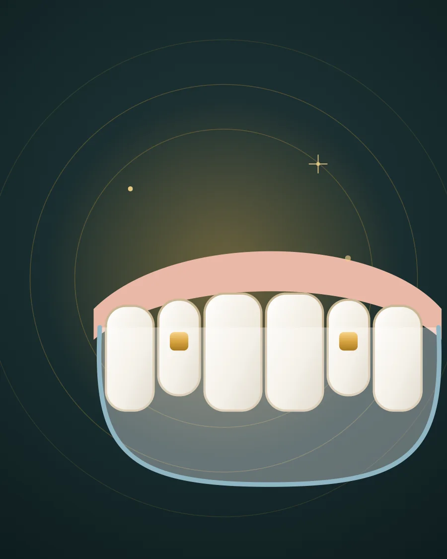 Illustration of upper front teeth covered by a clear aligner tray with small attachments, drawn in Elite Dental gold and charcoal