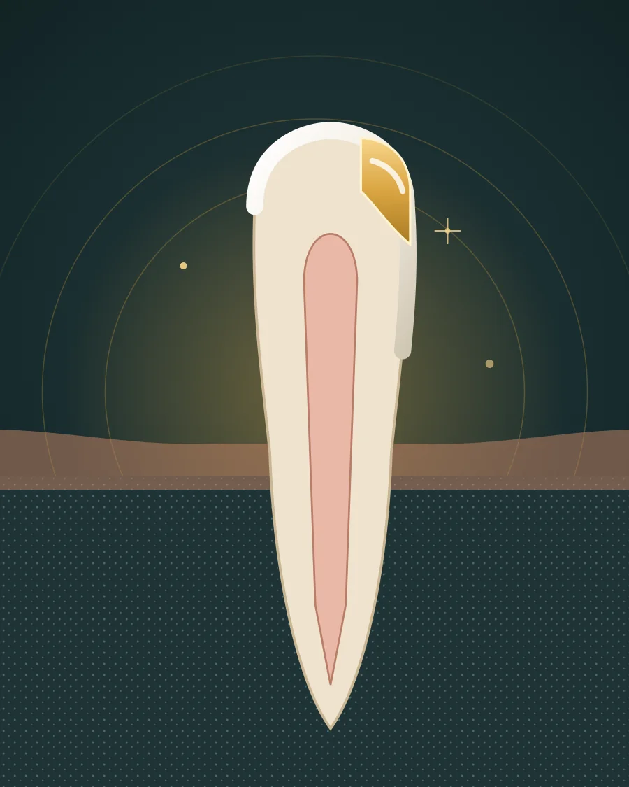 Illustration of a front tooth with a chipped corner rebuilt in gold-coloured bonding material, drawn in Elite Dental gold and charcoal