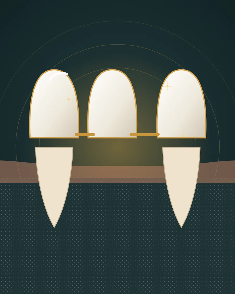 Illustration of a three-tooth dental bridge with crowns on the teeth either side of a gap, drawn in Elite Dental gold and charcoal