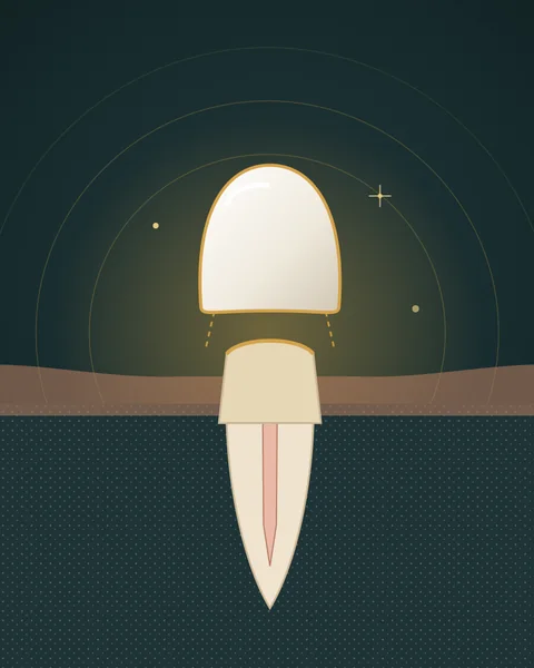 Illustration of a crown covering a prepared tooth