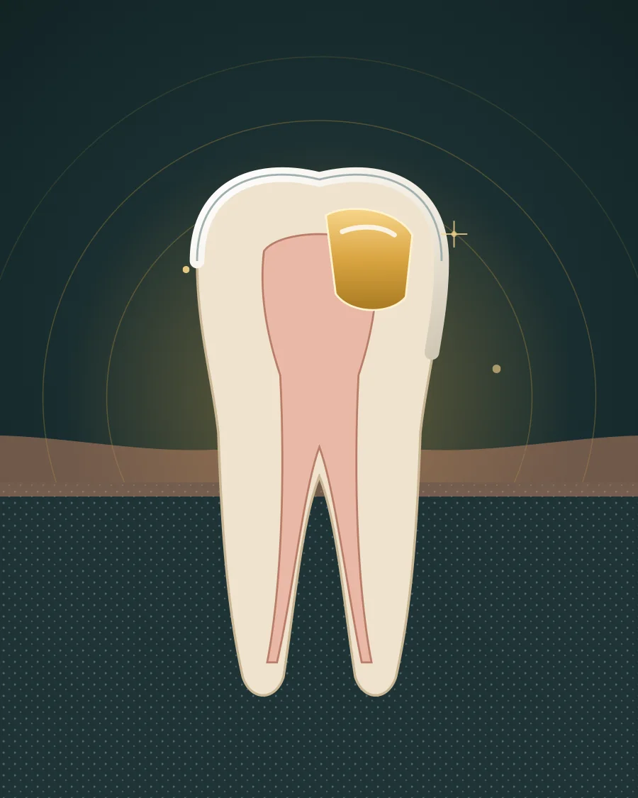 Illustration of a tooth cut open with a cavity filled with gold-coloured filling material, drawn in Elite Dental gold and charcoal