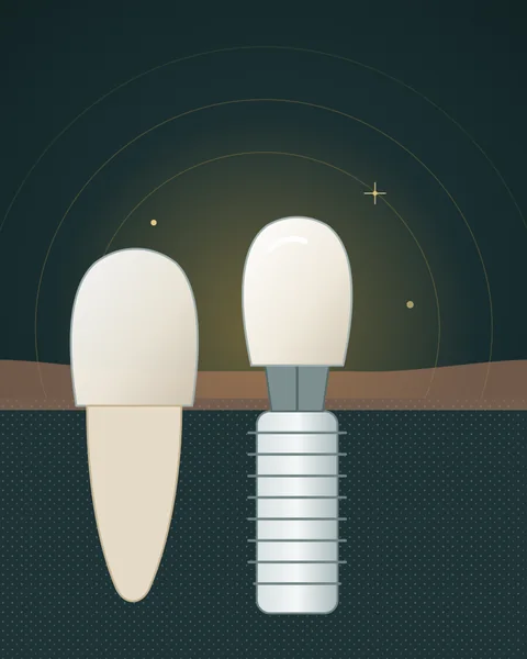 Illustration of a dental implant post with a crown