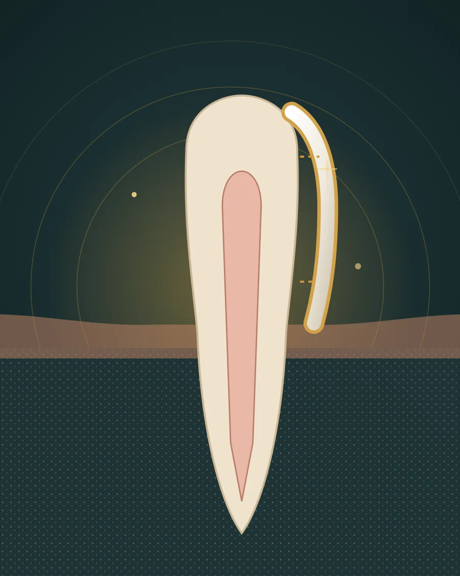 Illustration of a thin veneer shell fixed to the front of a front tooth, drawn in Elite Dental gold and charcoal