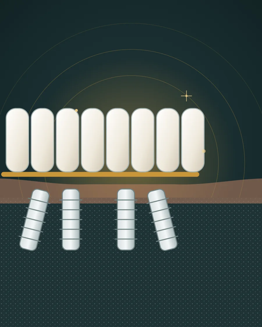 Illustration of a full row of teeth fixed on four implants set in the jawbone, drawn in Elite Dental gold and charcoal