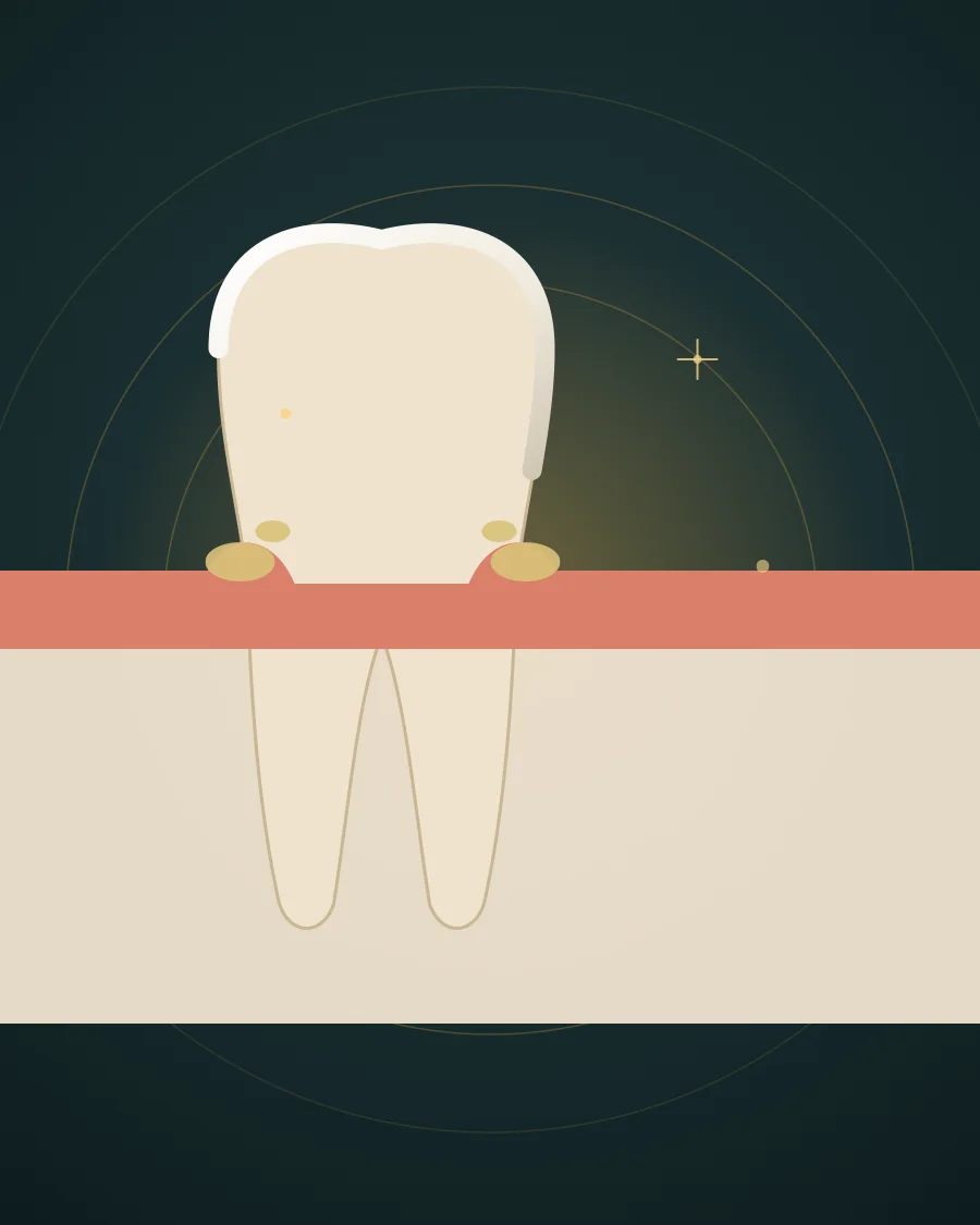 Illustration of a tooth with plaque at the gum line and red swollen gum while the bone below stays intact, drawn in Elite Dental gold and charcoal