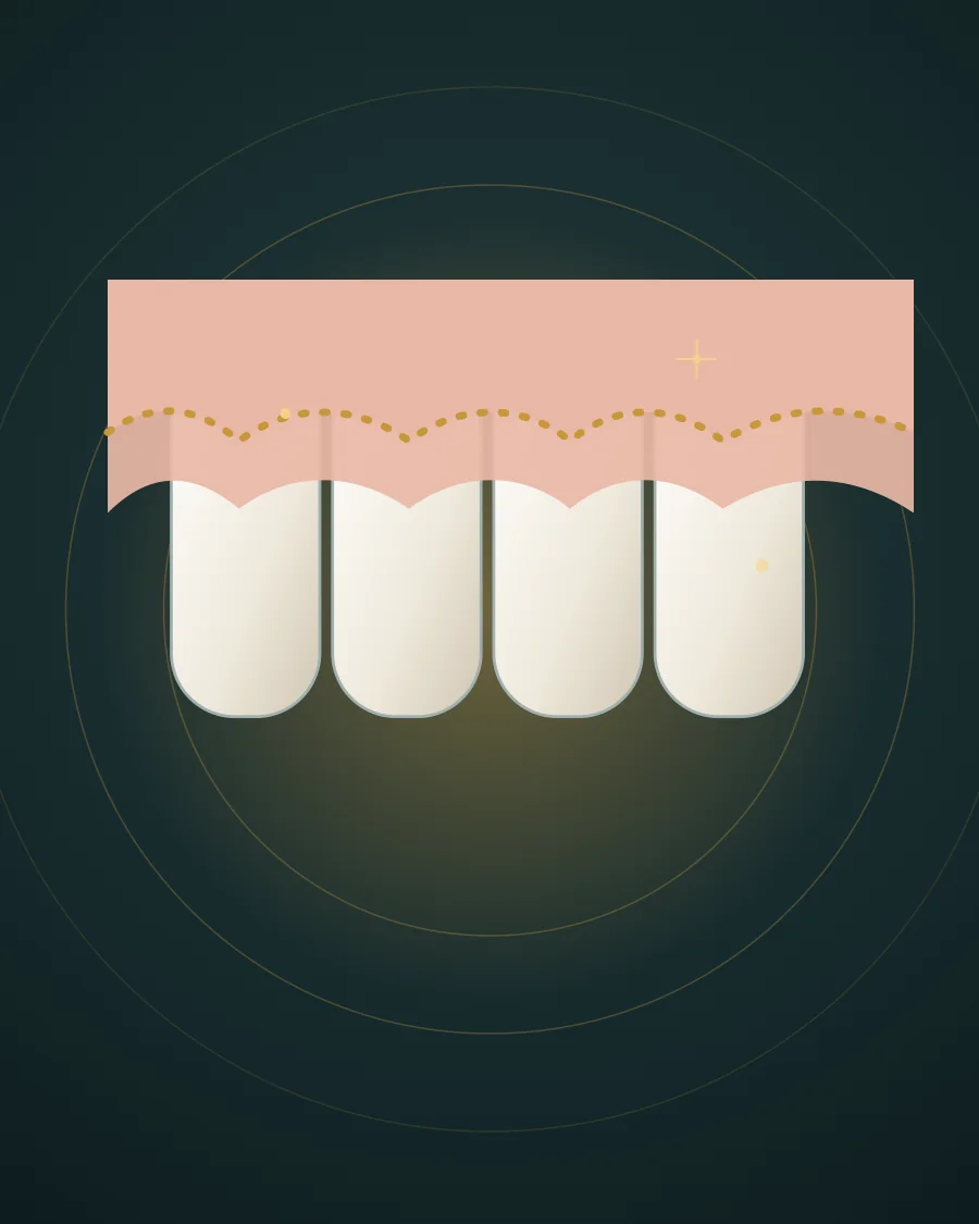 Illustration of four upper teeth with the gum line shown before and after reshaping by a dotted gold line, drawn in Elite Dental gold and charcoal