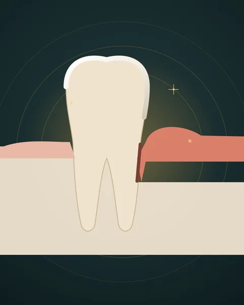 Illustration of a tooth with healthy and diseased gum