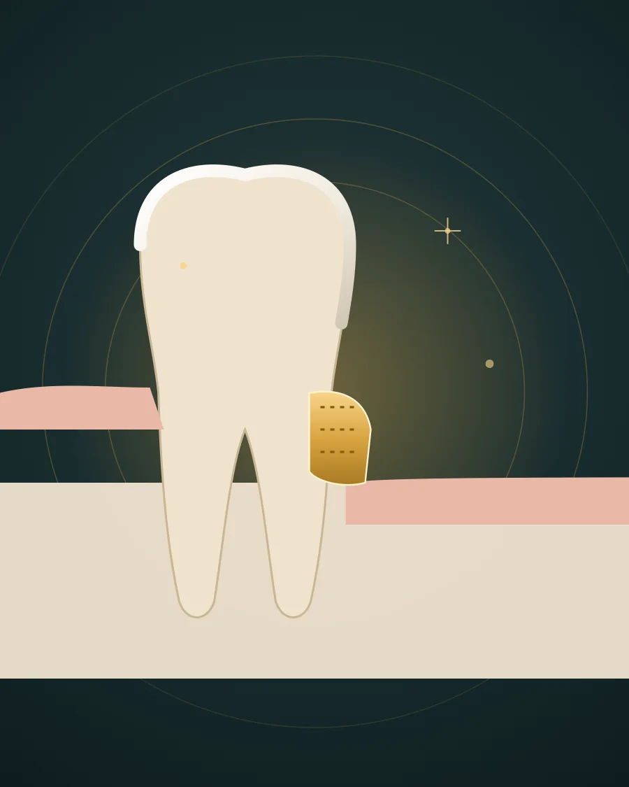 Illustration of a tooth with receded gum and a thin graft placed over the exposed root with stitches, drawn in Elite Dental gold and charcoal