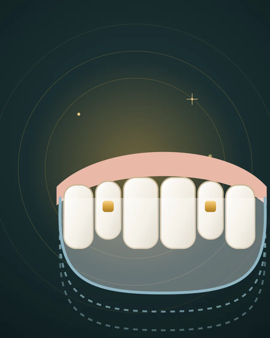 Illustration of upper teeth in a clear aligner tray with outlines of the next trays in the series, drawn in Elite Dental gold and charcoal