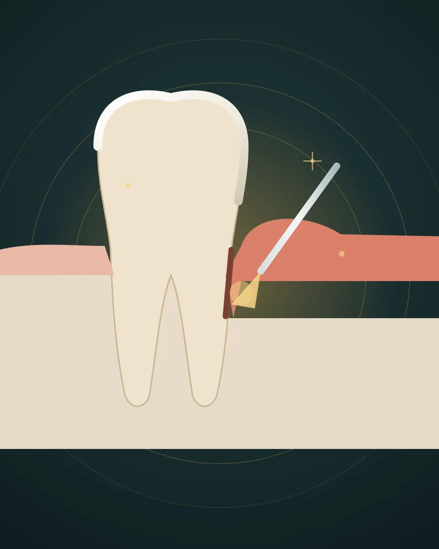 Illustration of a tooth with gum disease and a thin laser fibre directing light into the gum pocket, drawn in Elite Dental gold and charcoal