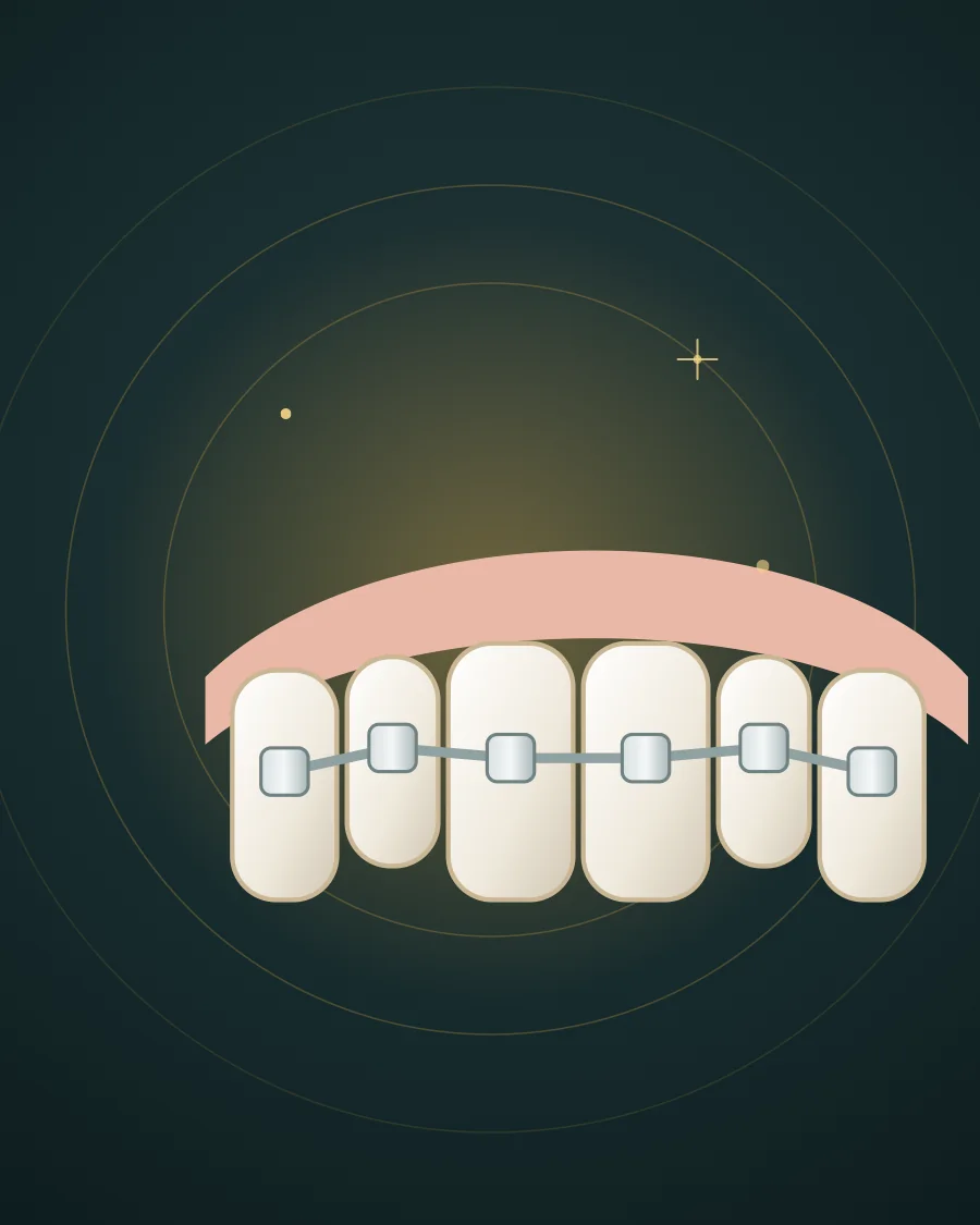 Illustration of six upper teeth with stainless steel brackets joined by a wire, drawn in Elite Dental gold and charcoal