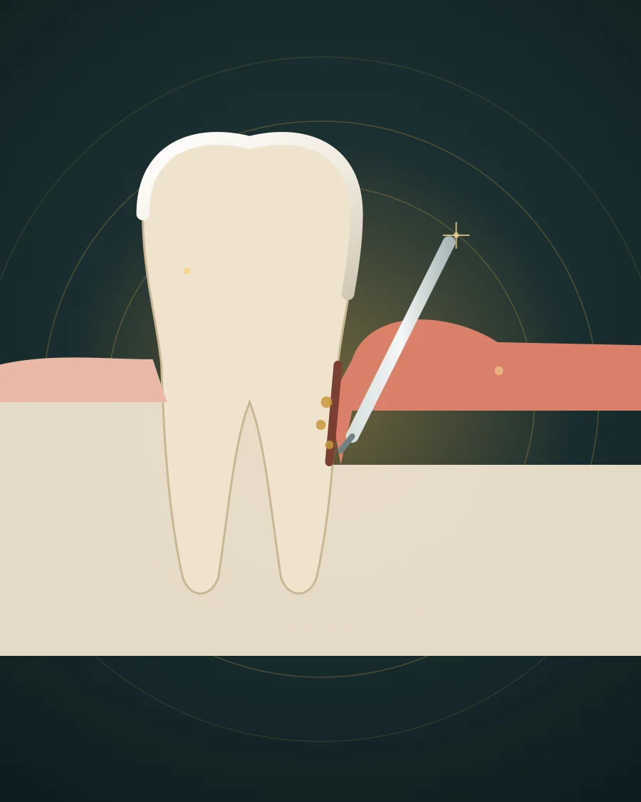 Illustration of a tooth with gum disease and a thin scaler cleaning tartar from the deep pocket below the gum line, drawn in Elite Dental gold and charcoal