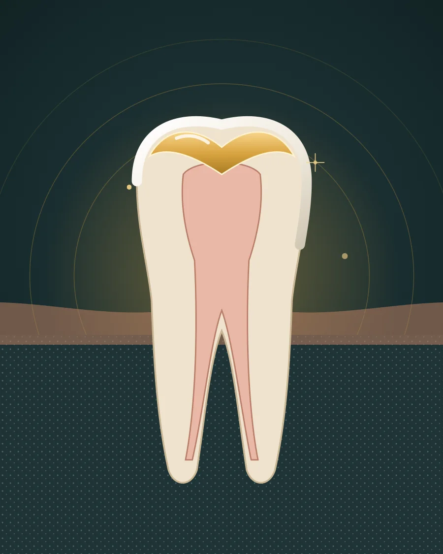 Illustration of a back tooth with a thin gold sealant filling the deep groove on its chewing surface, drawn in Elite Dental gold and charcoal