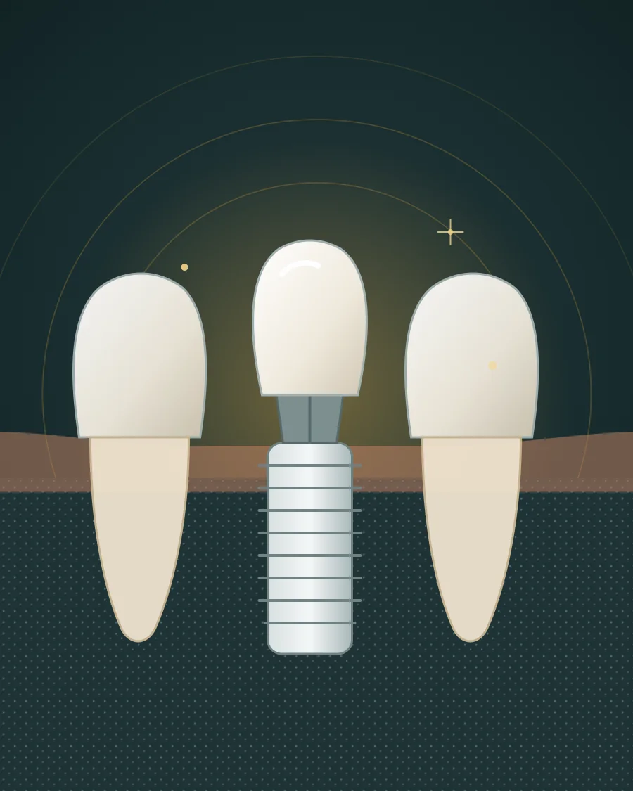 Illustration of one missing tooth replaced by an implant post, abutment and crown between two natural teeth, drawn in Elite Dental gold and charcoal