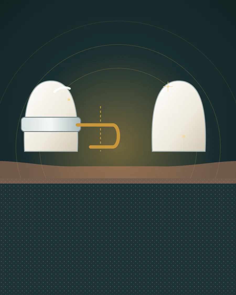 Illustration of a band on a back tooth with a wire loop holding open the gap where a baby tooth was lost, drawn in Elite Dental gold and charcoal