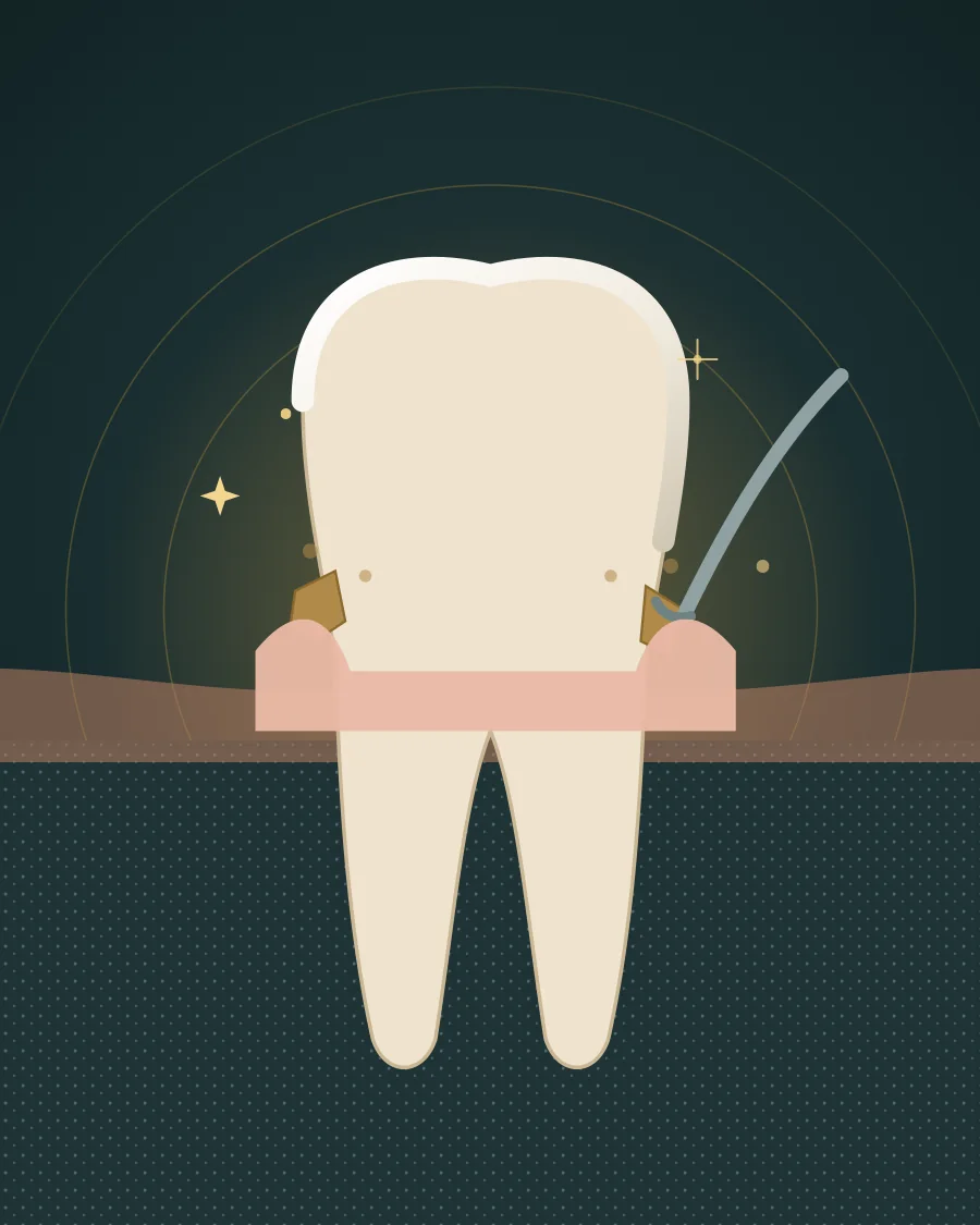 Illustration of a tooth with tartar at the gum line and a scaler removing it, drawn in Elite Dental gold and charcoal