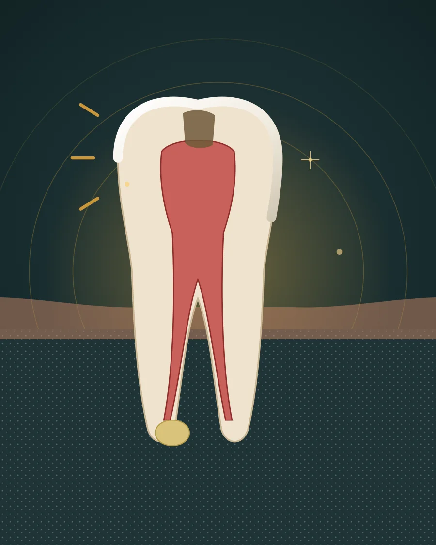 Illustration of a back tooth with decay reaching an inflamed nerve and a pocket of infection at the tip of the root, drawn in Elite Dental gold and charcoal