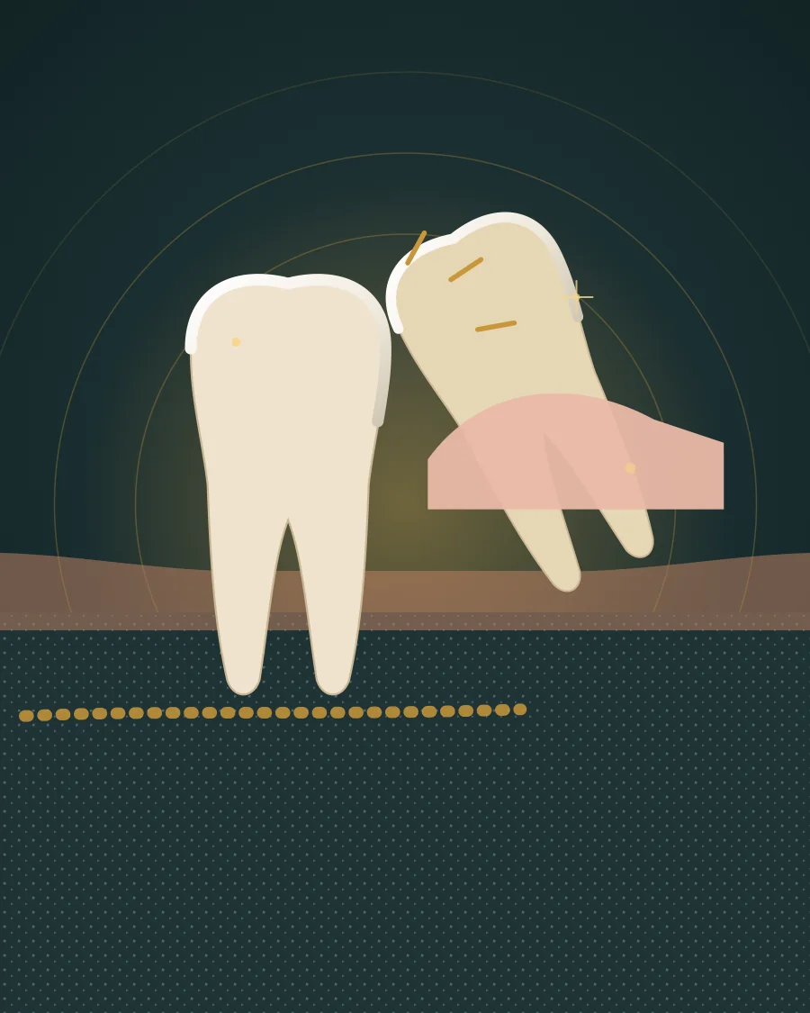 Illustration of the lower jaw with a wisdom tooth tilted against the second molar, partly covered by gum, with short gold lines showing pain, drawn in Elite Dental gold and charcoal
