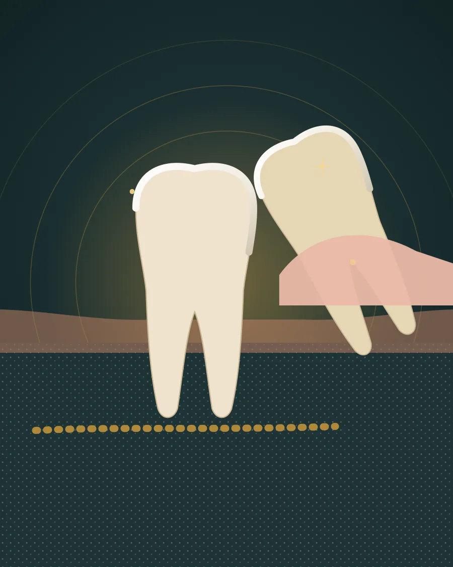 Illustration of a tilted wisdom tooth partly covered by gum beside the second molar, above the jaw nerve, drawn in Elite Dental gold and charcoal